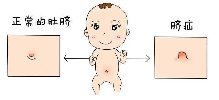 西安哪里医院治疗疝气好？小儿疝气的原因